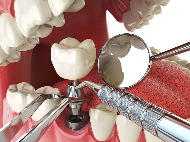Best Emergency Treatment for Dental Infections or Abscesses in Portola, CA